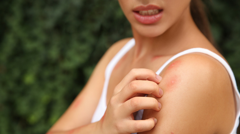 woman scratching mosquito bite