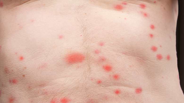 Bed bugs bites