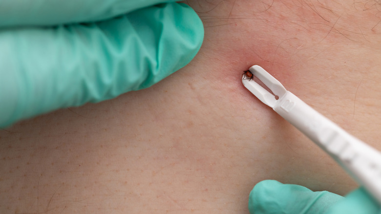 A tick is being removed from someone's skin with a pair of tweezers.