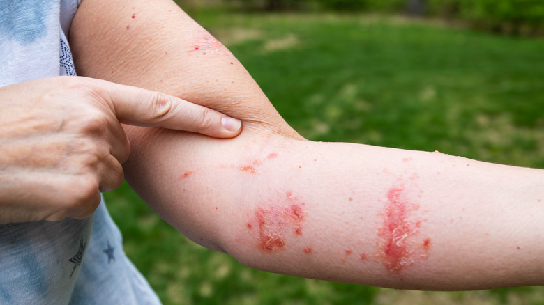 person allergic reaction from poison ivy