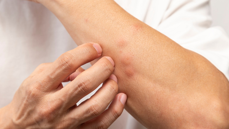 A person with several big bites on their left arm, with their right hand coming up to scratch against a white shirt background