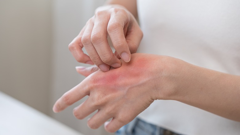 A woman scratches an allergic reaction on her hands.