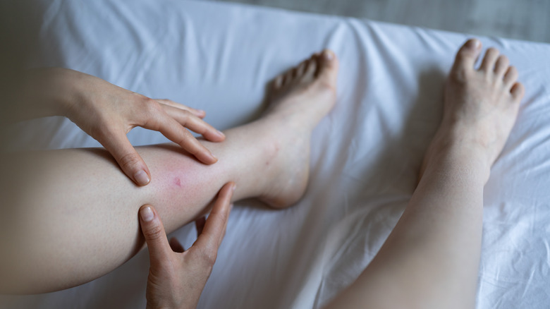 woman on bed bedbug bite