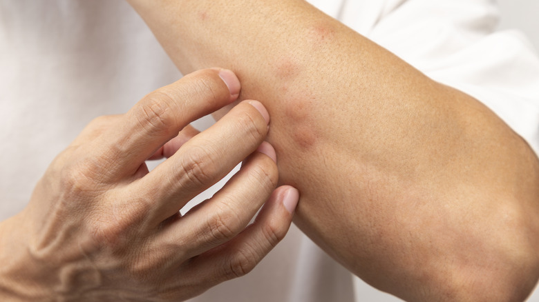 Person scratching bug bites on arm