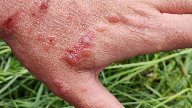 Burns caused by giant hogweed