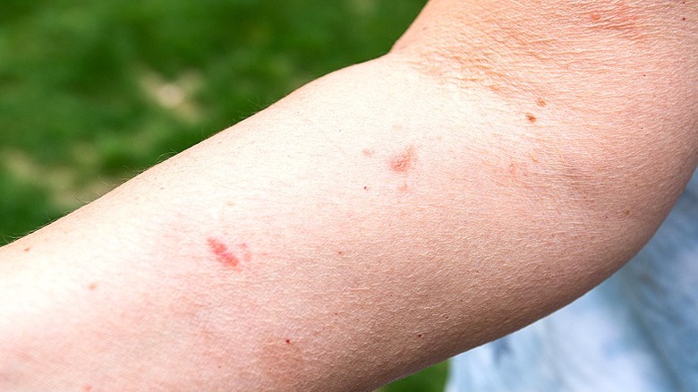 Poison ivy on skin