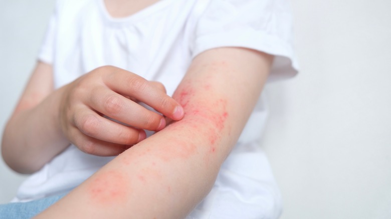 Child suffering allergic reaction